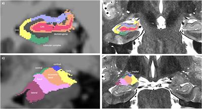 Case Report: An MRI Traumatic Brain Injury Longitudinal Case Study at 7 Tesla: Pre- and Post-injury Structural Network and Volumetric Reorganization and Recovery